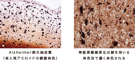 Alzheimer病大脳皮質 Alzheimer病大脳皮質
